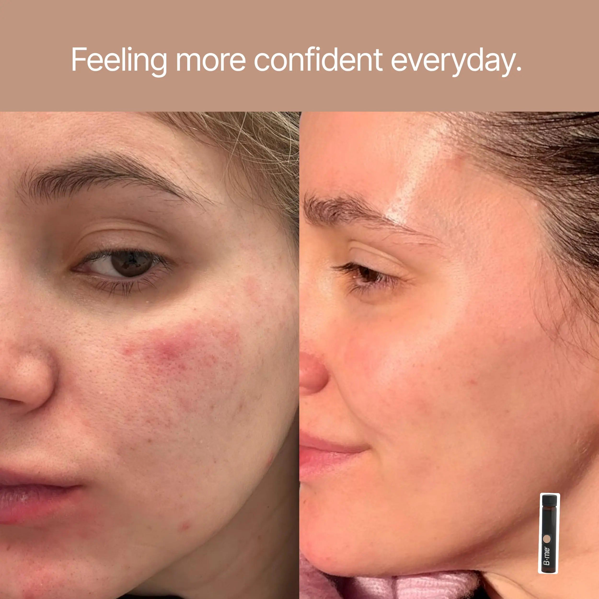 B.me® Gentle Skin+ – Complément alimentaire pour la peau sensible et sujette aux rougeurs