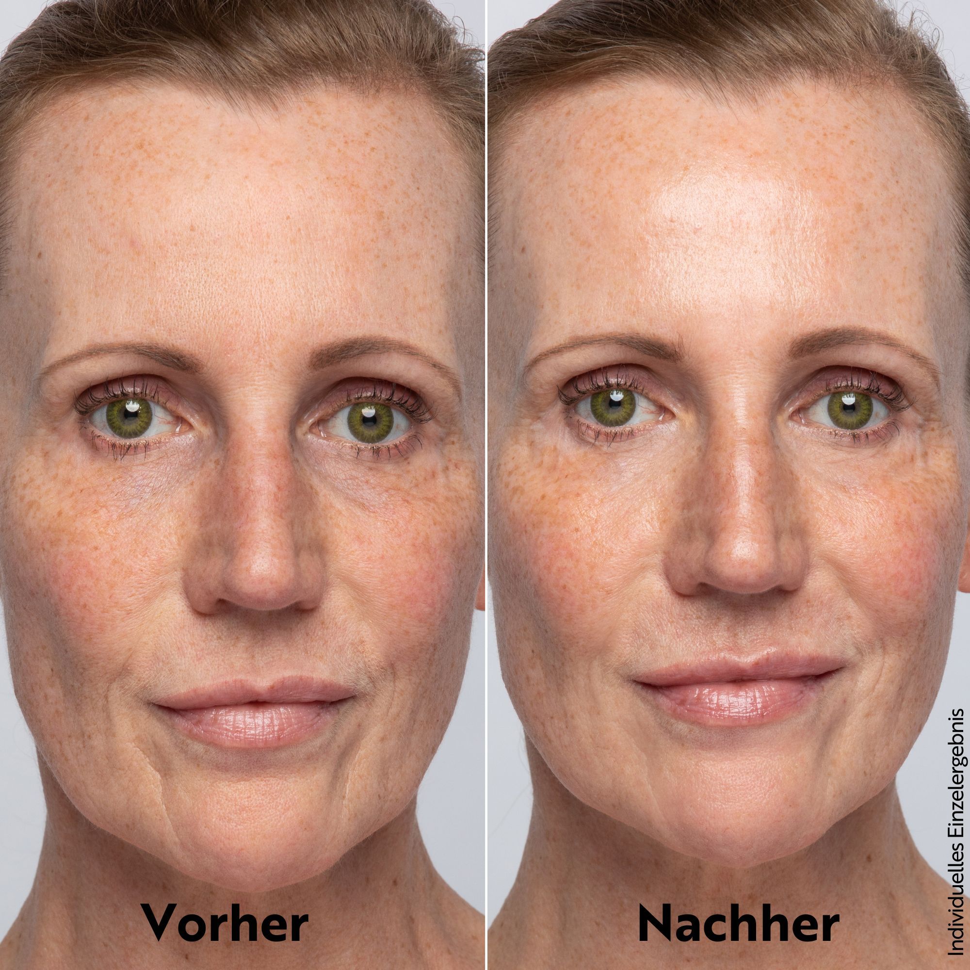 Voor-na vergelijking. Vrouw met huidonzuiverheden links, gladde huid rechts. Tekst: Voor, Na.