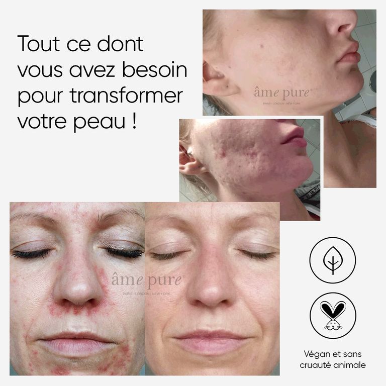 Photos avant/après d'un traitement de la peau.