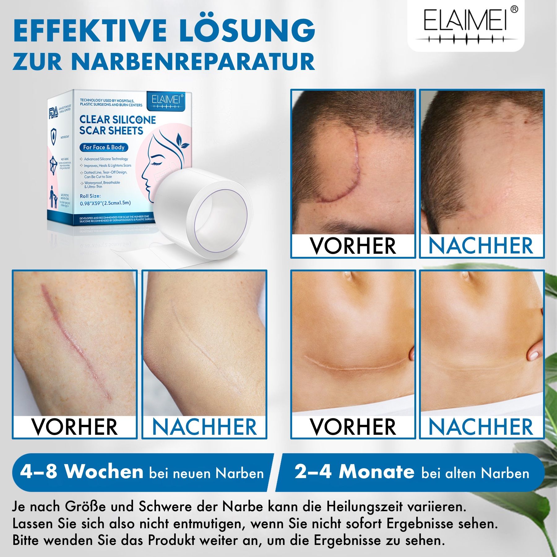 Voor- en na foto's van littekens. ELAIMEI Clear Silicone Scar Sheets. Tekst: Effectieve oplossing voor littekenherstel. 4-8 weken, 2-4 maanden.