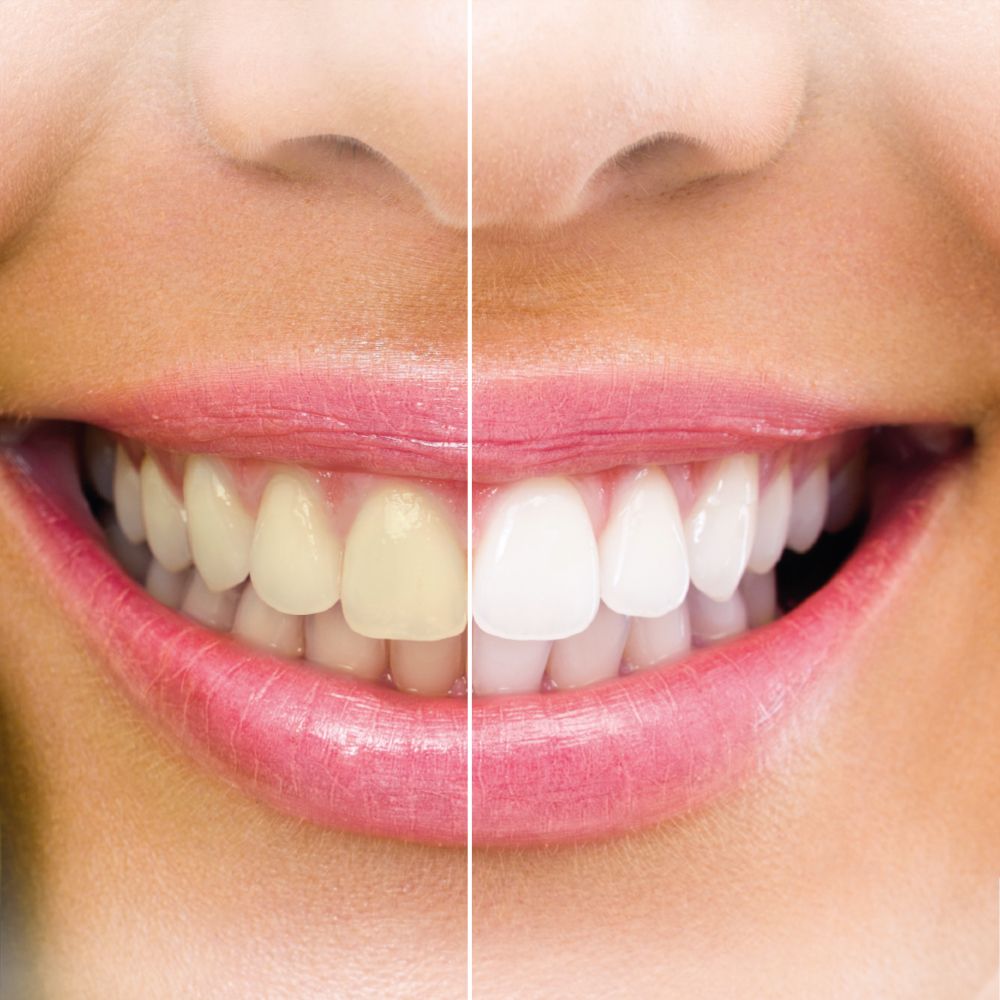 Gros plan d'une bouche. Dents avant et après traitement. Dents claires à droite, plus foncées à gauche.