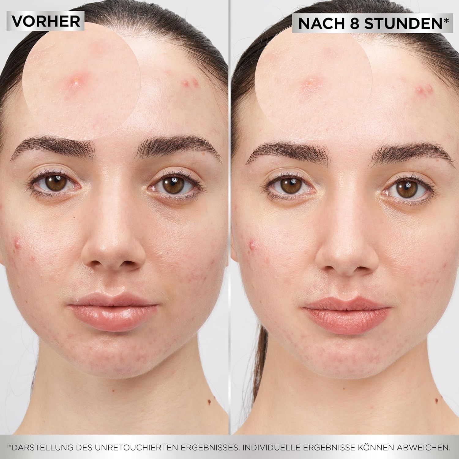 Comparaison avant-après. Deux visages. Gauche: imperfections. Droite: peau claire.