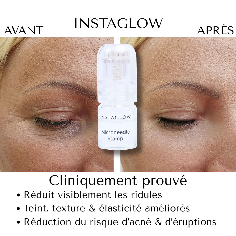 Image avant-après. Instaglow Microneedle Stamp. Réduit les rides, améliore la texture et l'élasticité de la peau.