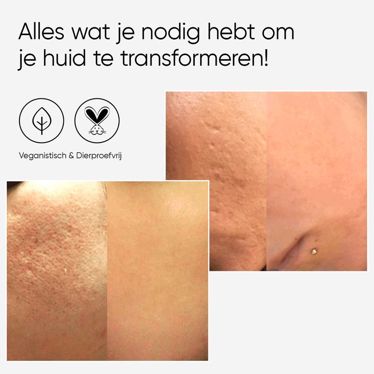 Vrouw met hoofdband gebruikt microneedling gezichtsroller op de wang.