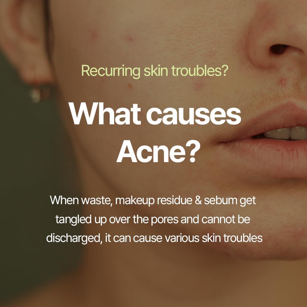 Gros plan sur un visage. Texte: What causes Acne? Lorsque les déchets, les résidus de maquillage et le sébum s'emmêlent, cela peut causer des problèmes de peau.