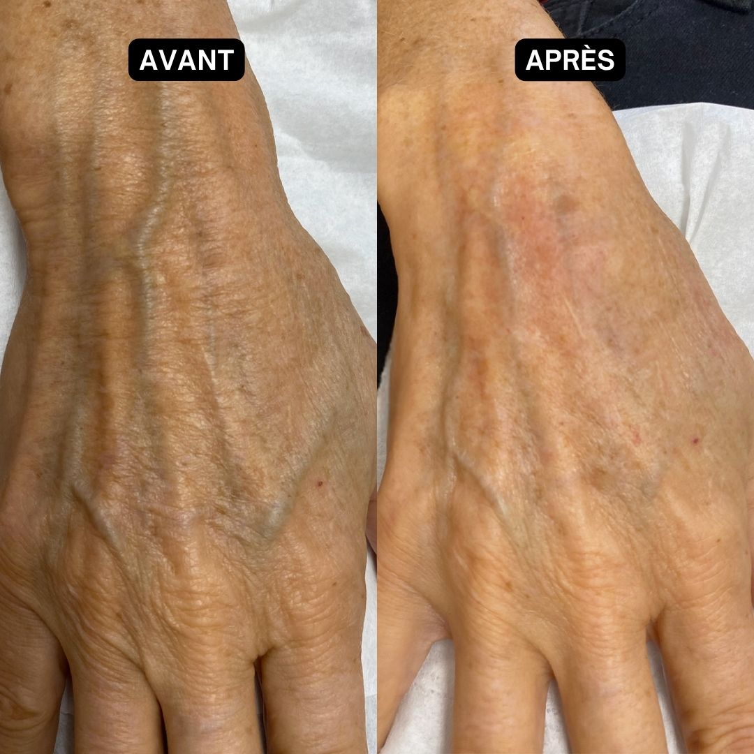 Deux mains, une avant et une après utilisation. La peau semble plus lisse et moins rouge après utilisation.