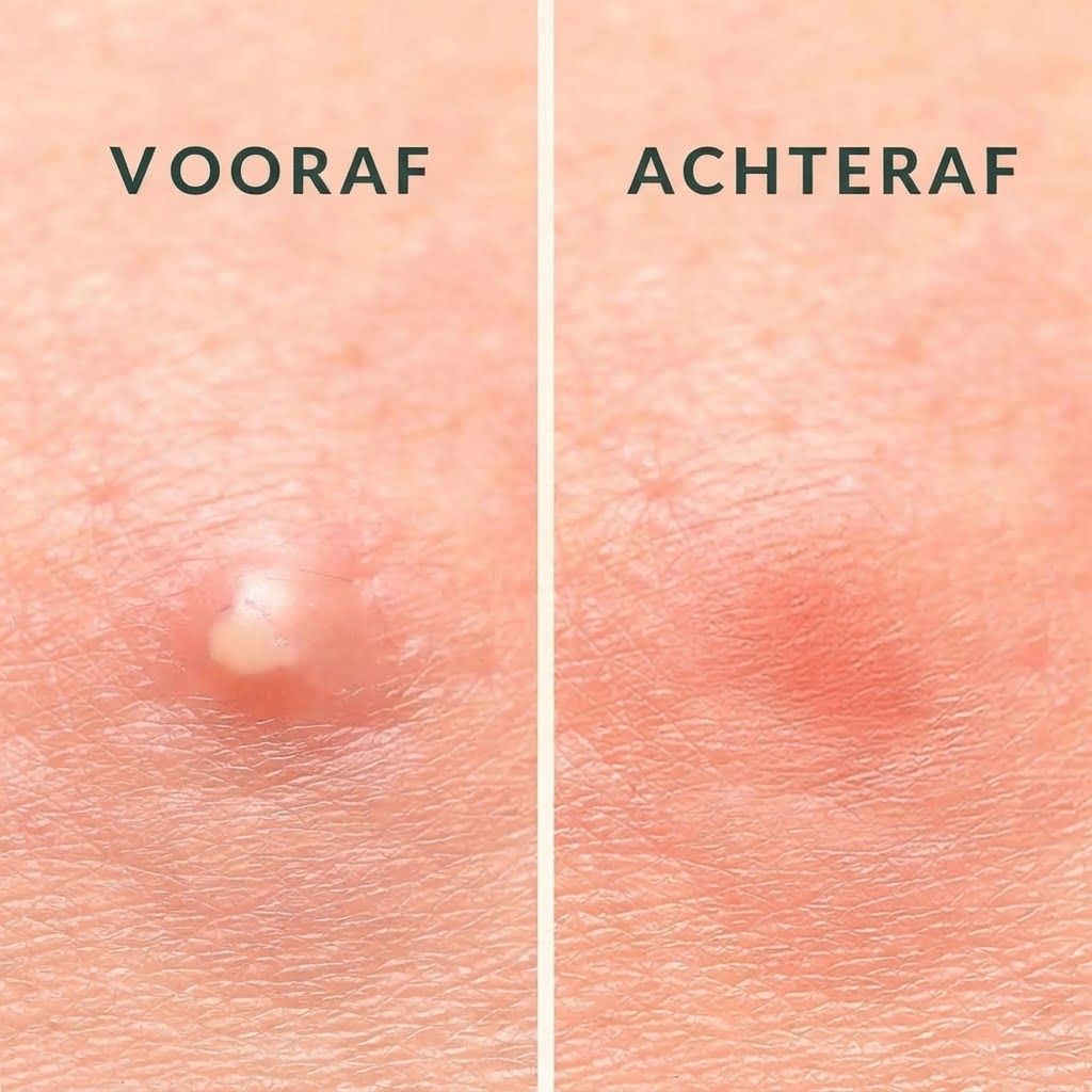 Voor-en-na vergelijking van huid met acne. Links: ontstoken puistje. Rechts: verminderde roodheid en zwelling.