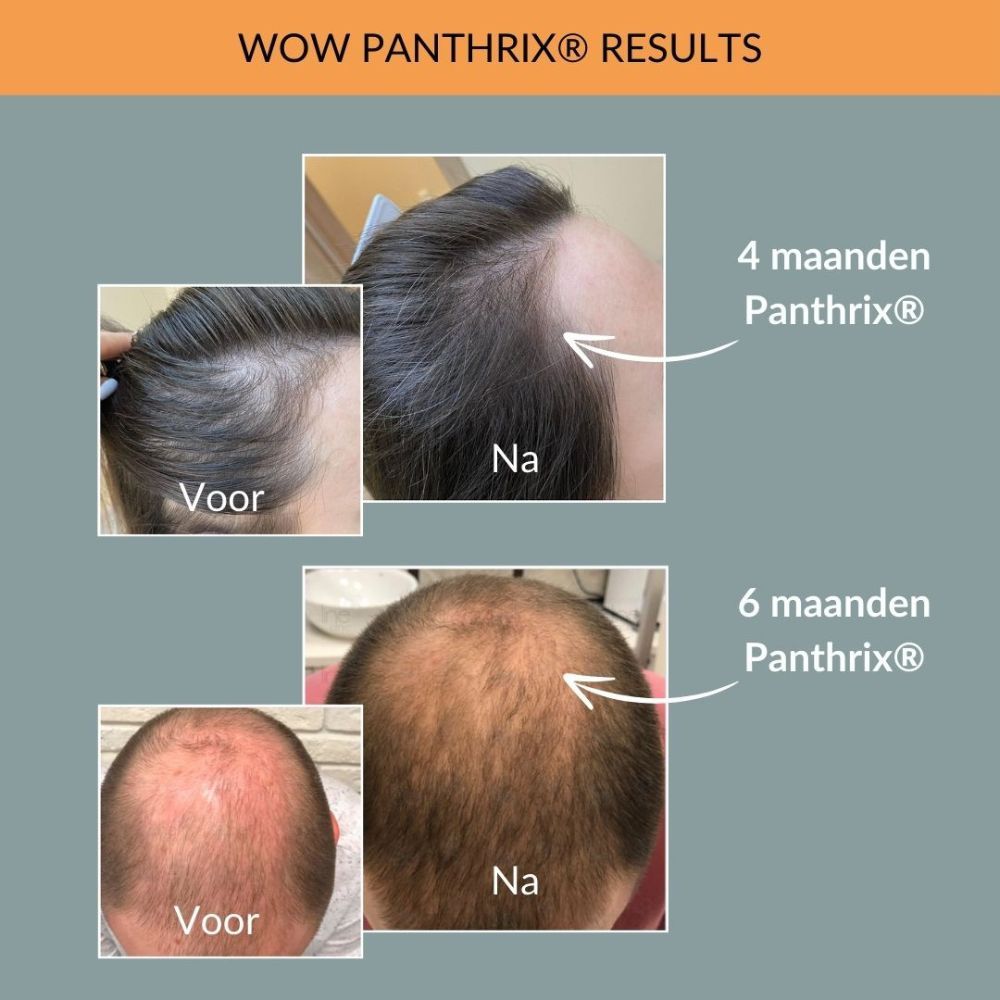 Voor- en na foto's van haar. Tekst: WOW Panthrix resultaten. 4 en 6 maanden.