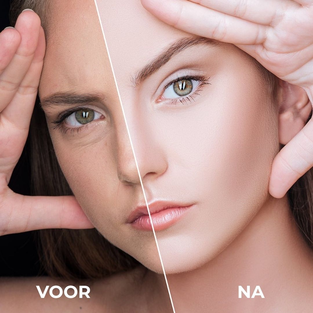 Voor-en-na vergelijking. Gezicht van een vrouw. Eén helft: onzuiverheden. Andere helft: gladde huid.