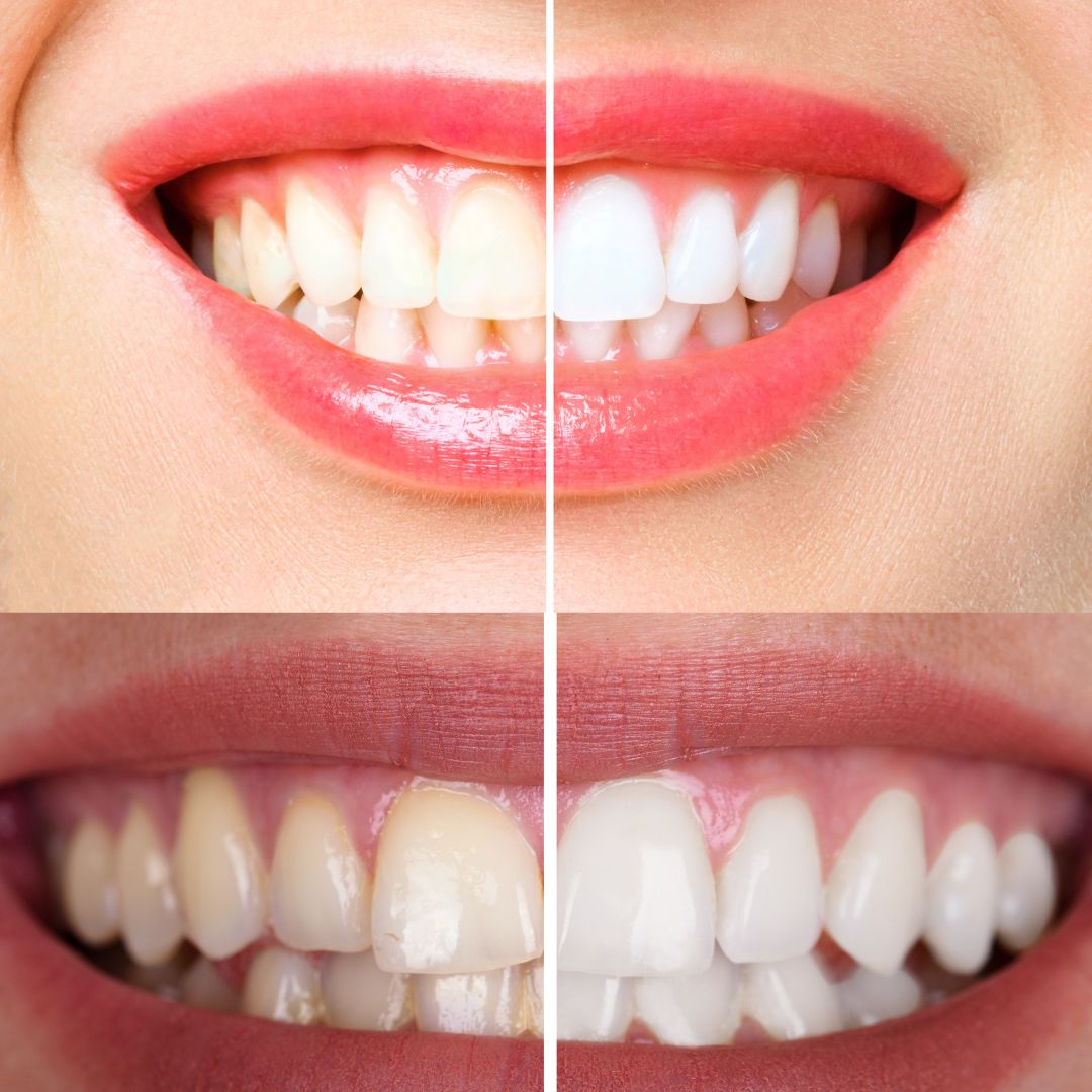 Comparaison dents avant/après. En haut: dents plus blanches. En bas: dents jaunâtres, puis dents plus blanches.