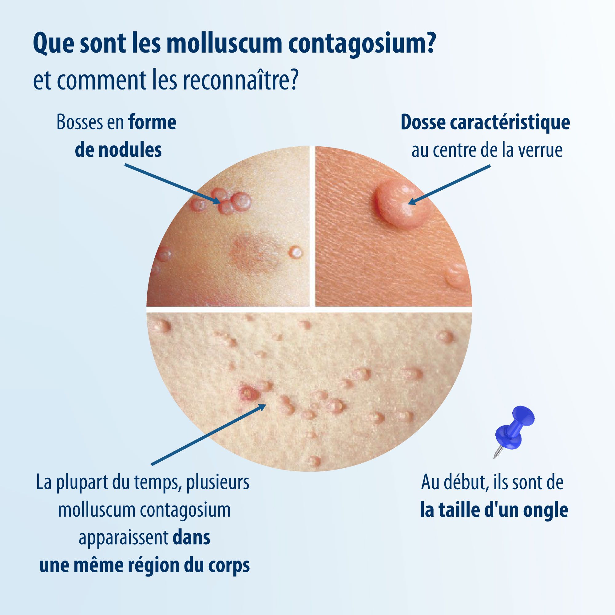 Graphique. Application contre les molluscum contagiosum. 1. Spatule. 2. Tamponner matin et soir. 3. Rougeur. 4. Guéri après 2-6 semaines.