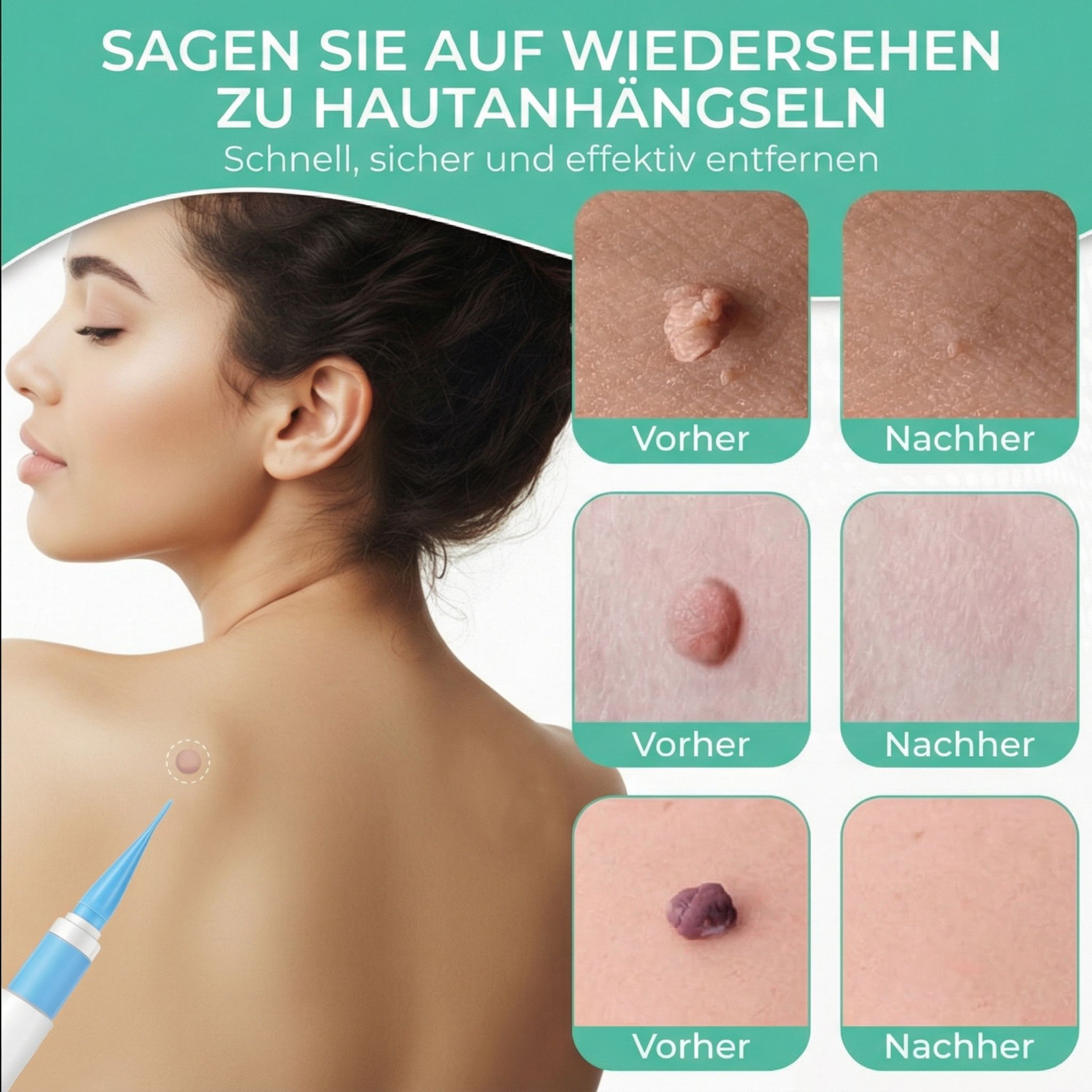 Voor- en na-afbeeldingen van huidlabels. Verwijdering met pen. Vrouw met huidlabel op rug.