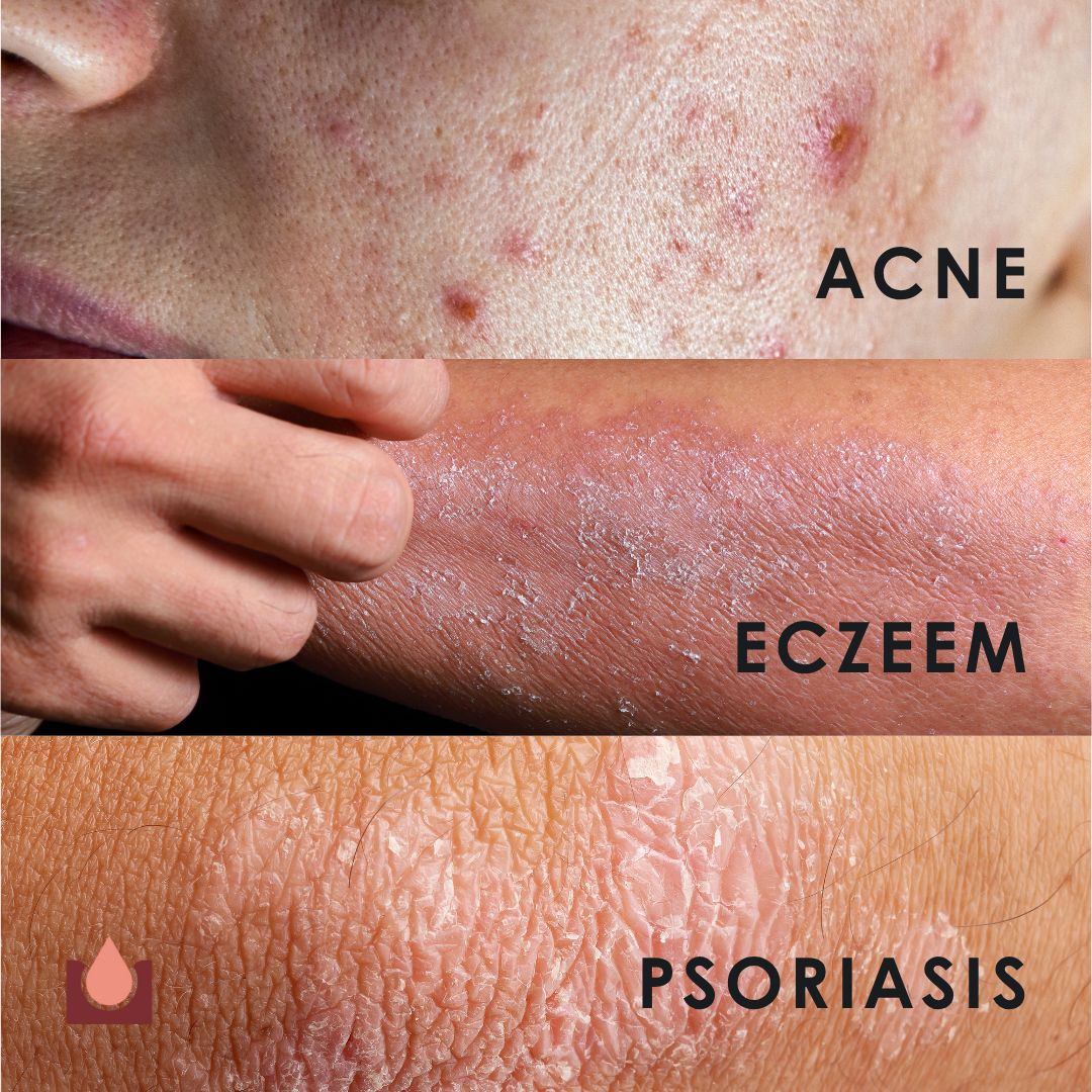Gros plans de peau avec acné, eczéma et psoriasis. Texte : Acné, eczéma, psoriasis.