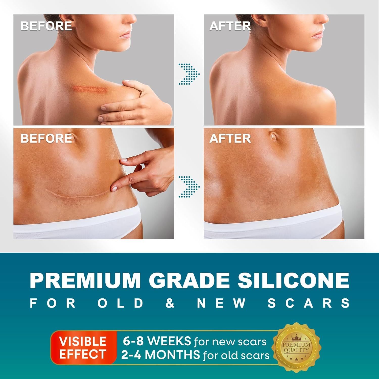 Vergelijkende afbeeldingen voor en na. Tekst: Premium siliconen voor oude en nieuwe littekens.