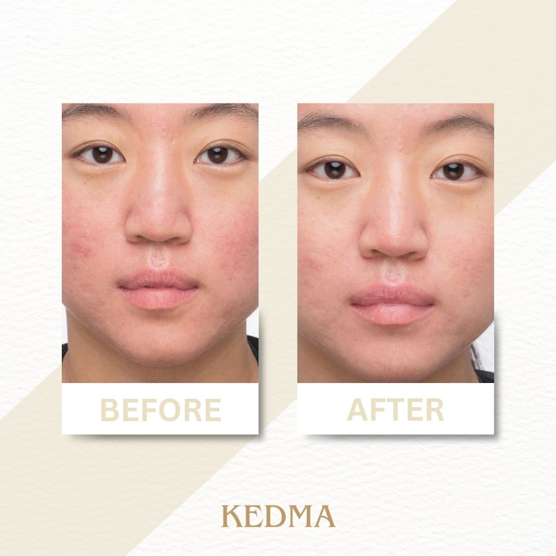 Kedma - Peeling Doux pour le Visage aux Extraits de Fruits