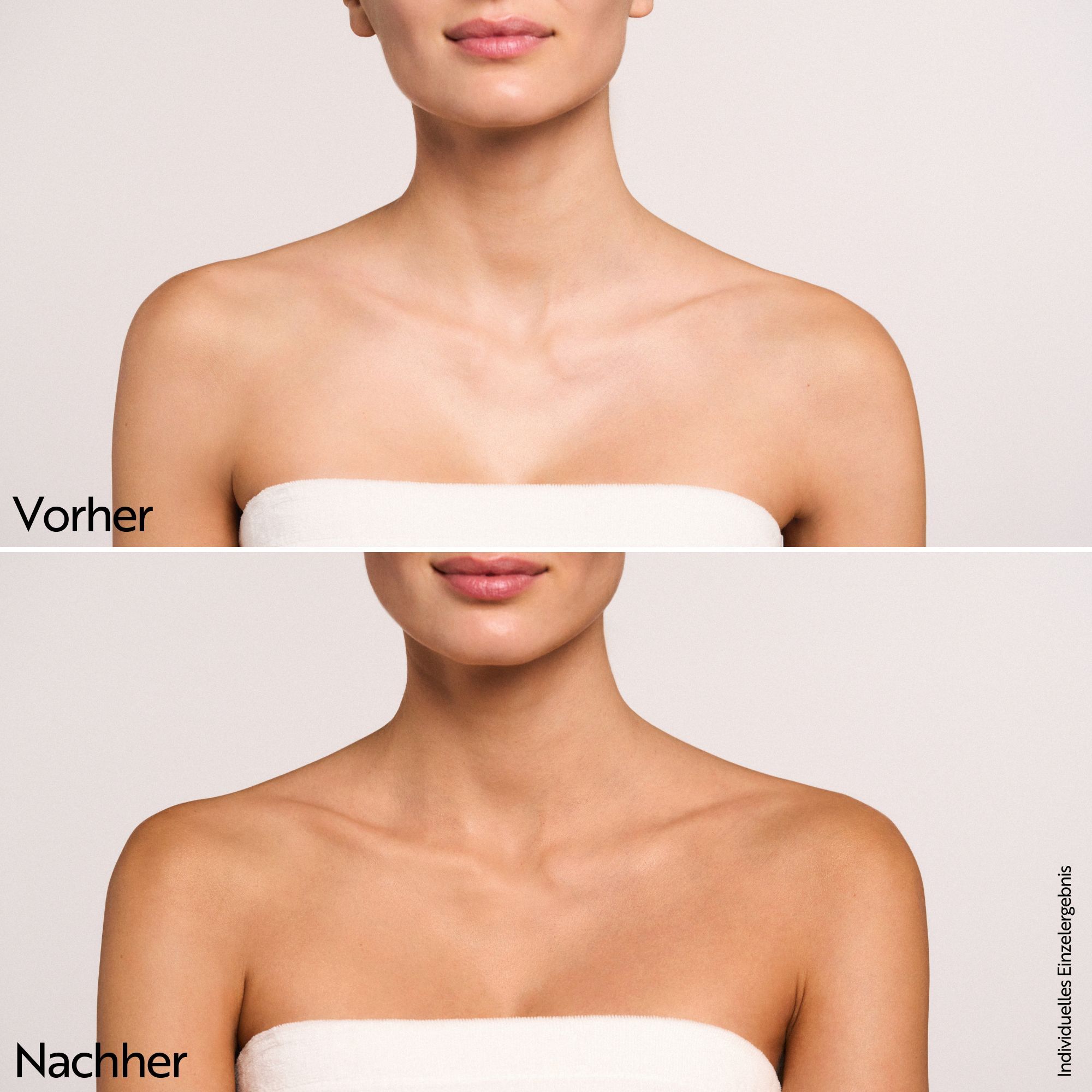 Comparaison avant-après. Haut du corps d'une femme. En haut: peau claire. En bas: peau bronzée.