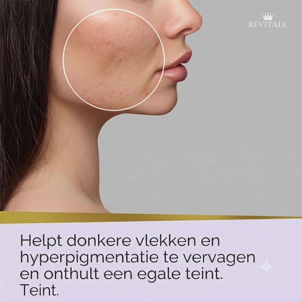 Profiel van een vrouw met huidonvolkomenheden en hyperpigmentatie op de wang, gemarkeerd met een cirkel.