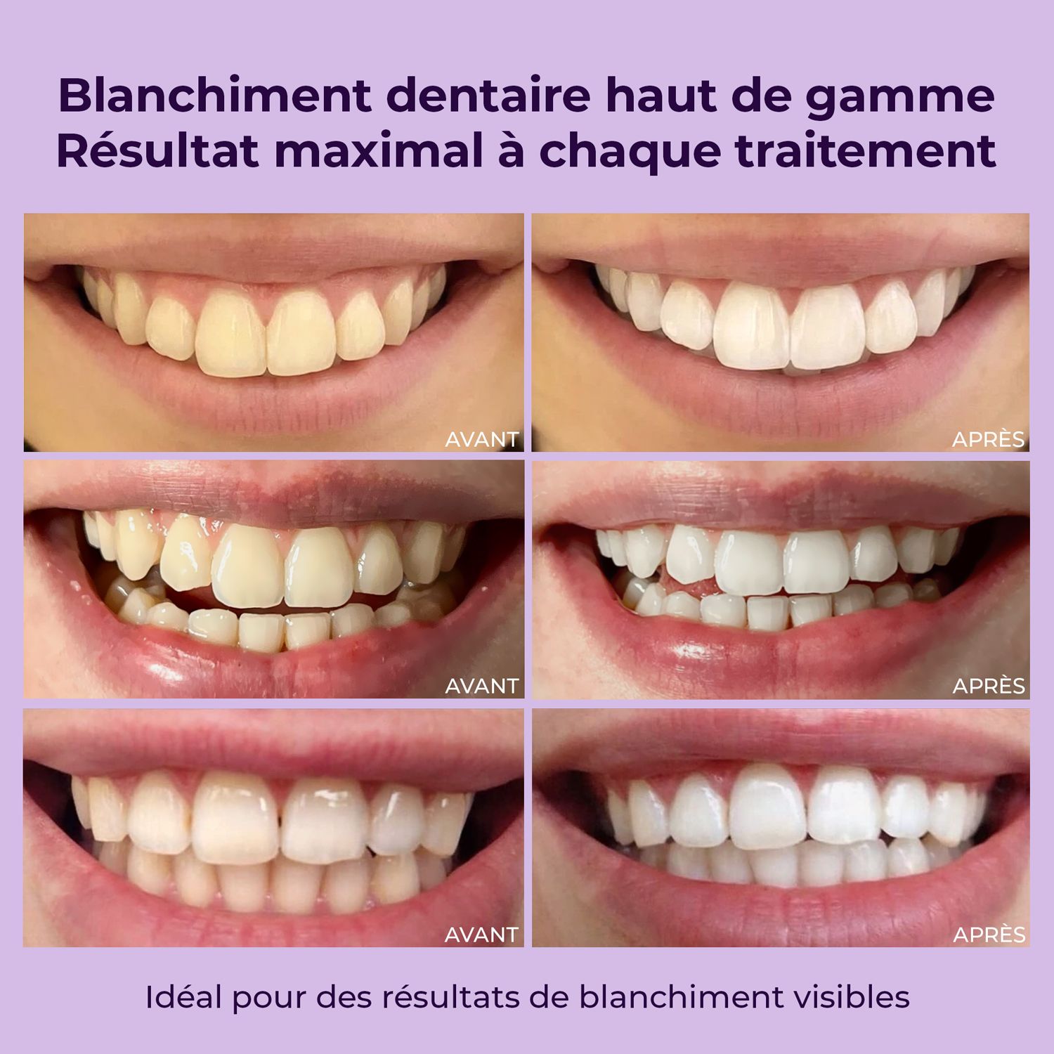 Comparaison avant-après des dents. Plusieurs rangées montrent les résultats du blanchiment.