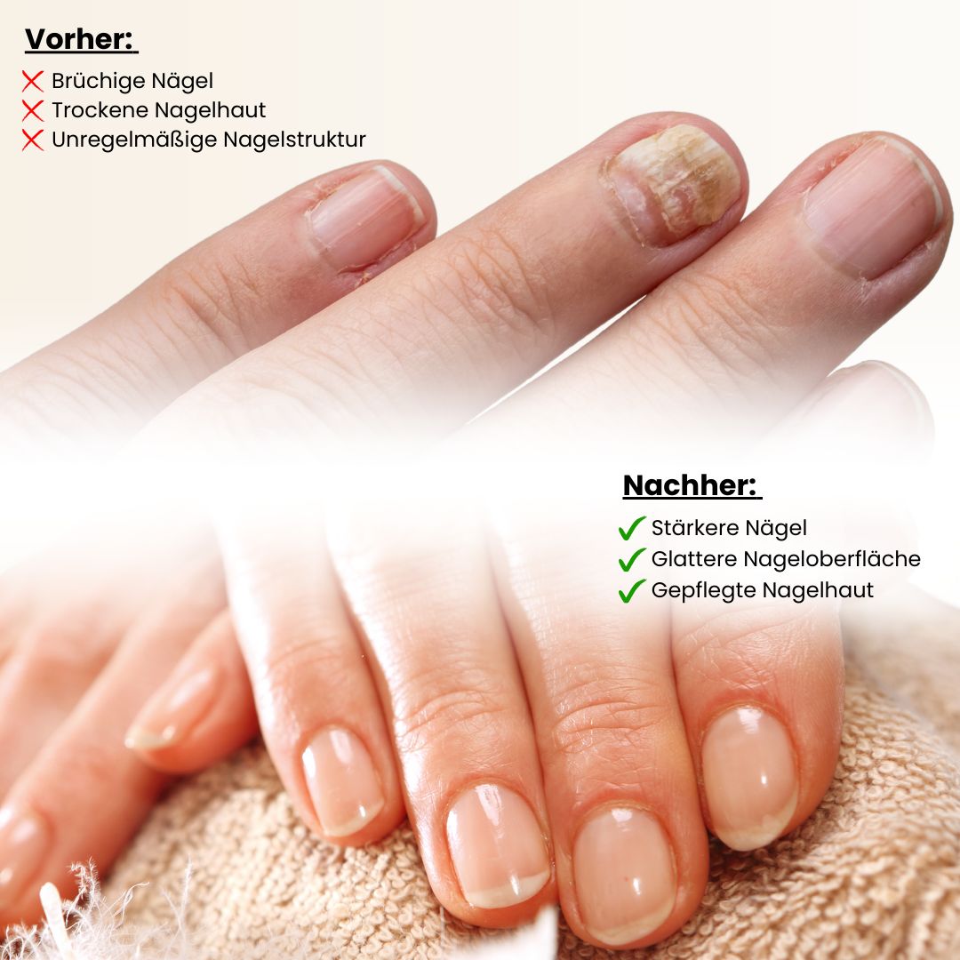 Comparaison avant-après des ongles. À gauche : ongles cassants. À droite : ongles plus forts, surface plus lisse, cuticules soignées.