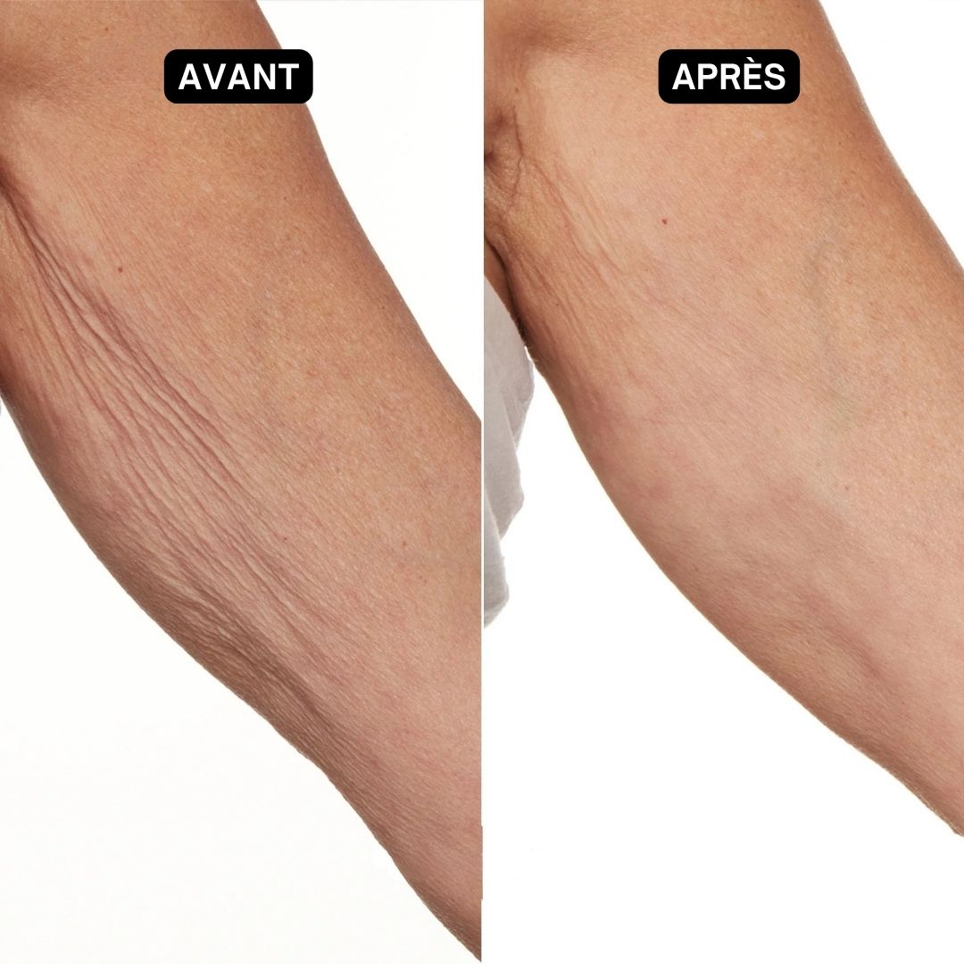 Deux bras, l'un avec peau ridée, l'autre lisse. Texte: Avant/Après.