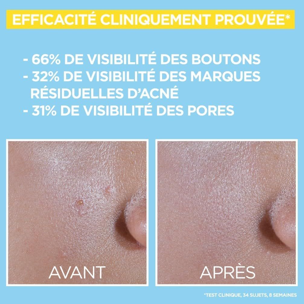 Comparaison avant-après de la peau montrant l'efficacité sur l'acné et les pores.