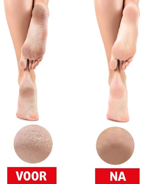 Images avant-après des pieds. Pieds avec et sans callosités. Champs de texte rouges.