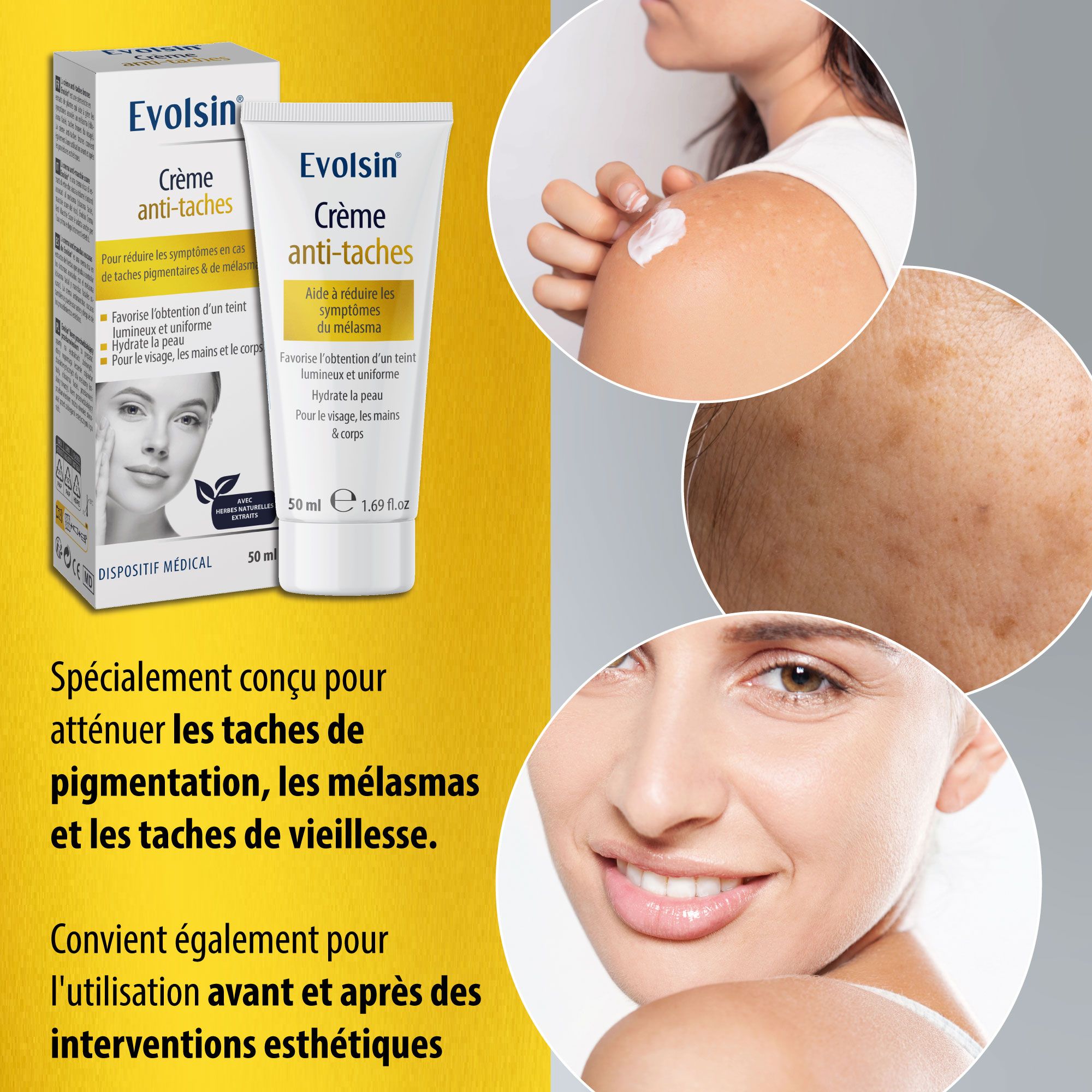 Femme avec taches pigmentaires. Crème et emballage EVOLSIN. Texte : Crème anti-taches. Dispositif médical.