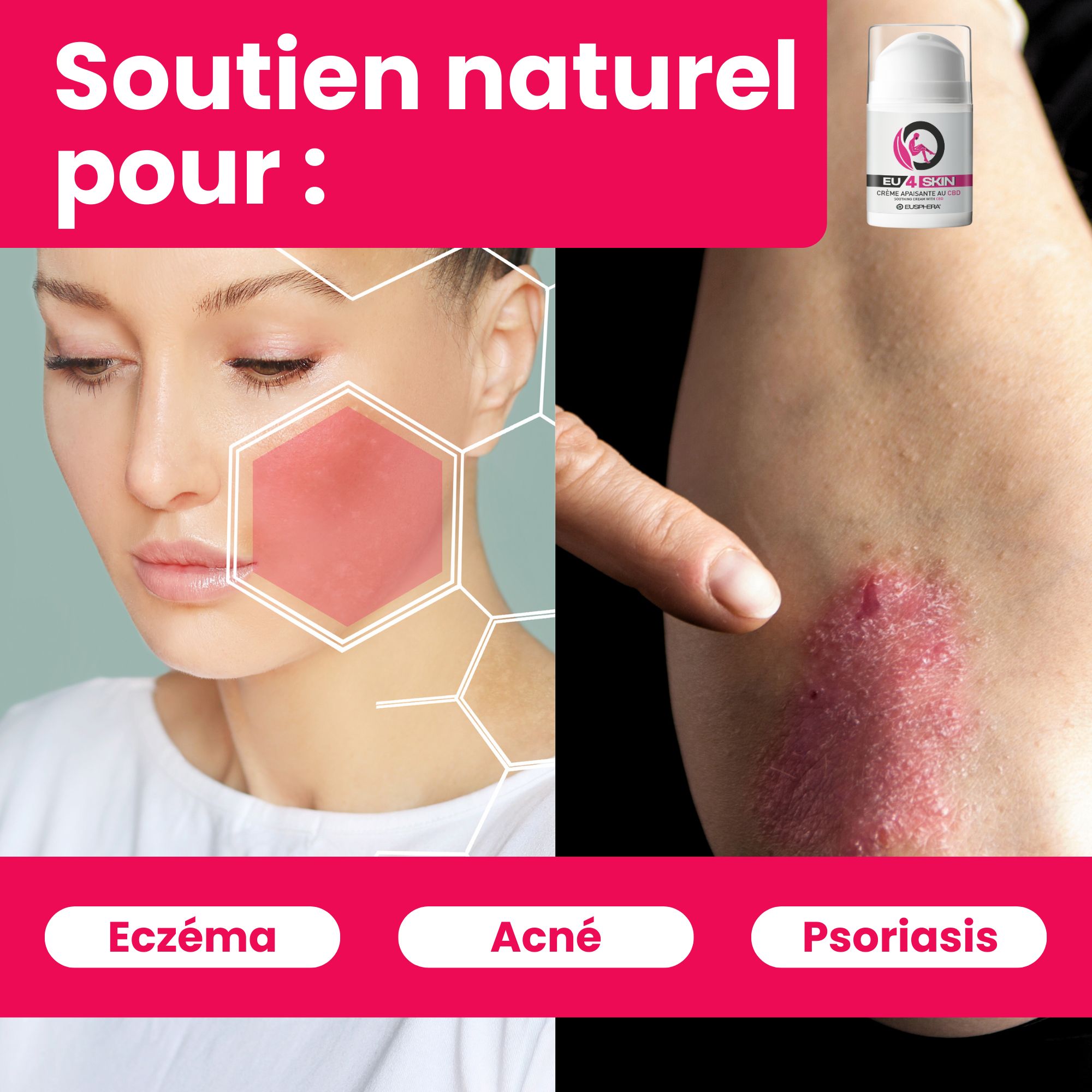 Crème apaisante au CBD pour l'acné, l'eczéma et le psoriasis | EU4DERMA - Eusphera