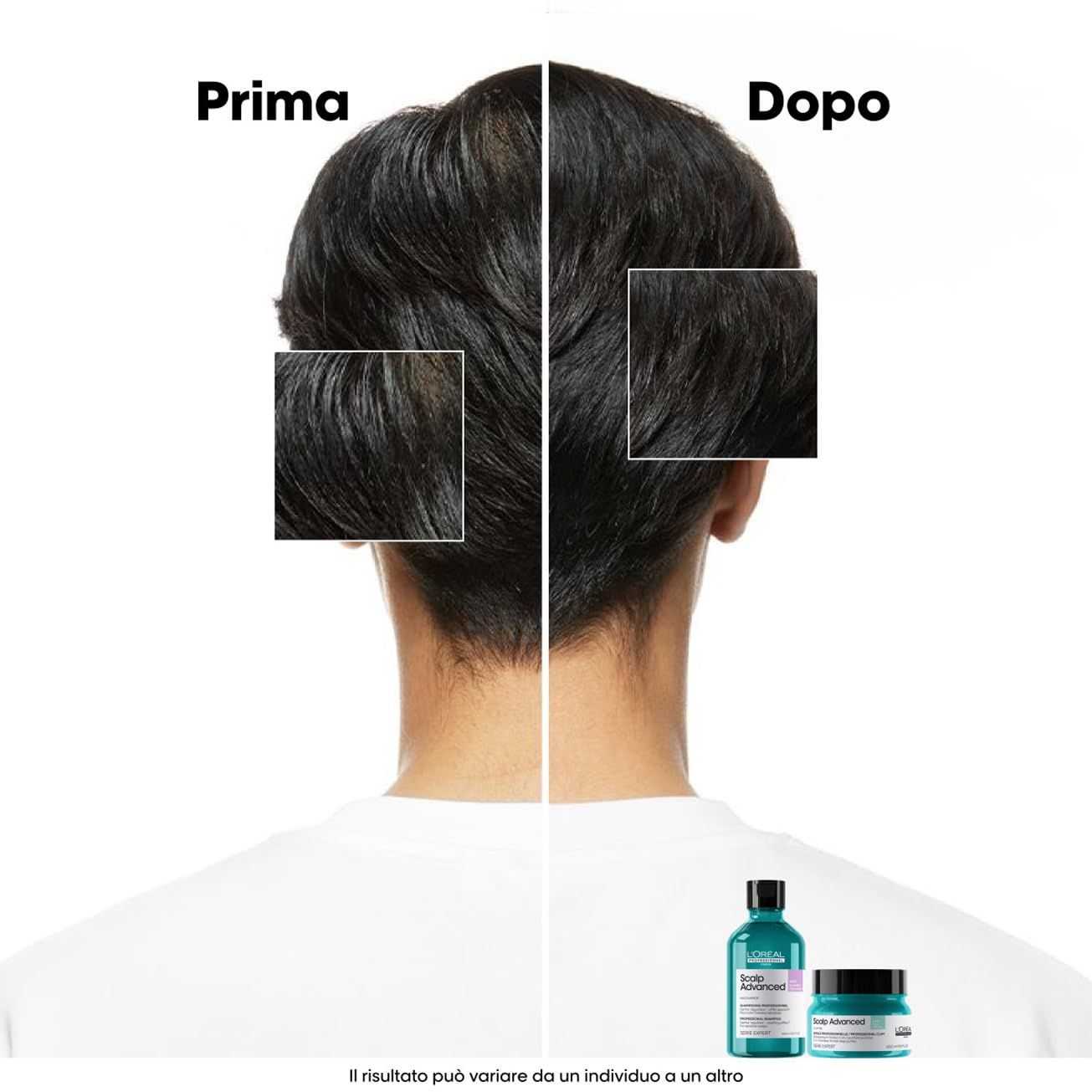 Comparaison avant-après du cuir chevelu et des cheveux. En bas : shampooing et crème. Texte : Prima, Dopo. L'Oréal Professionnel Scalp Advanced.
