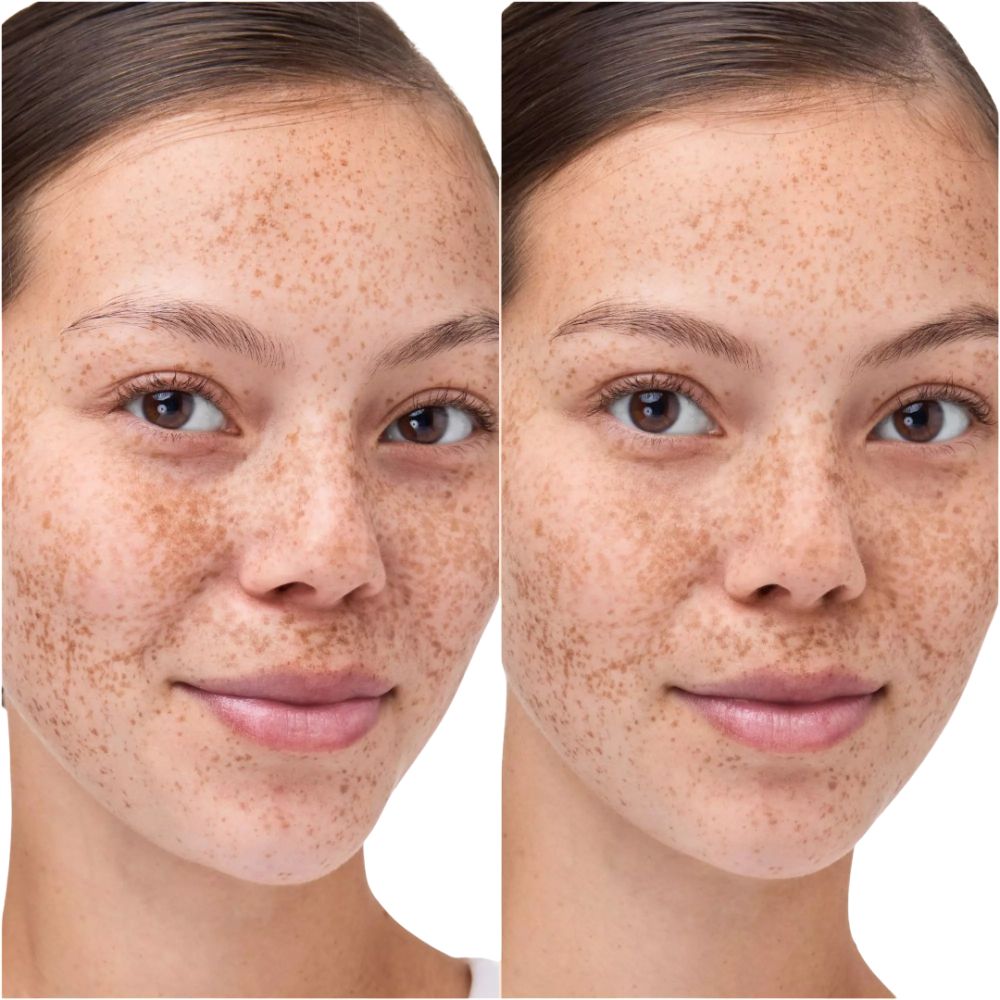 Comparaison avant-après. Visage d'une femme avec des taches de rousseur. Gauche : peau avec imperfections. Droite : peau améliorée.