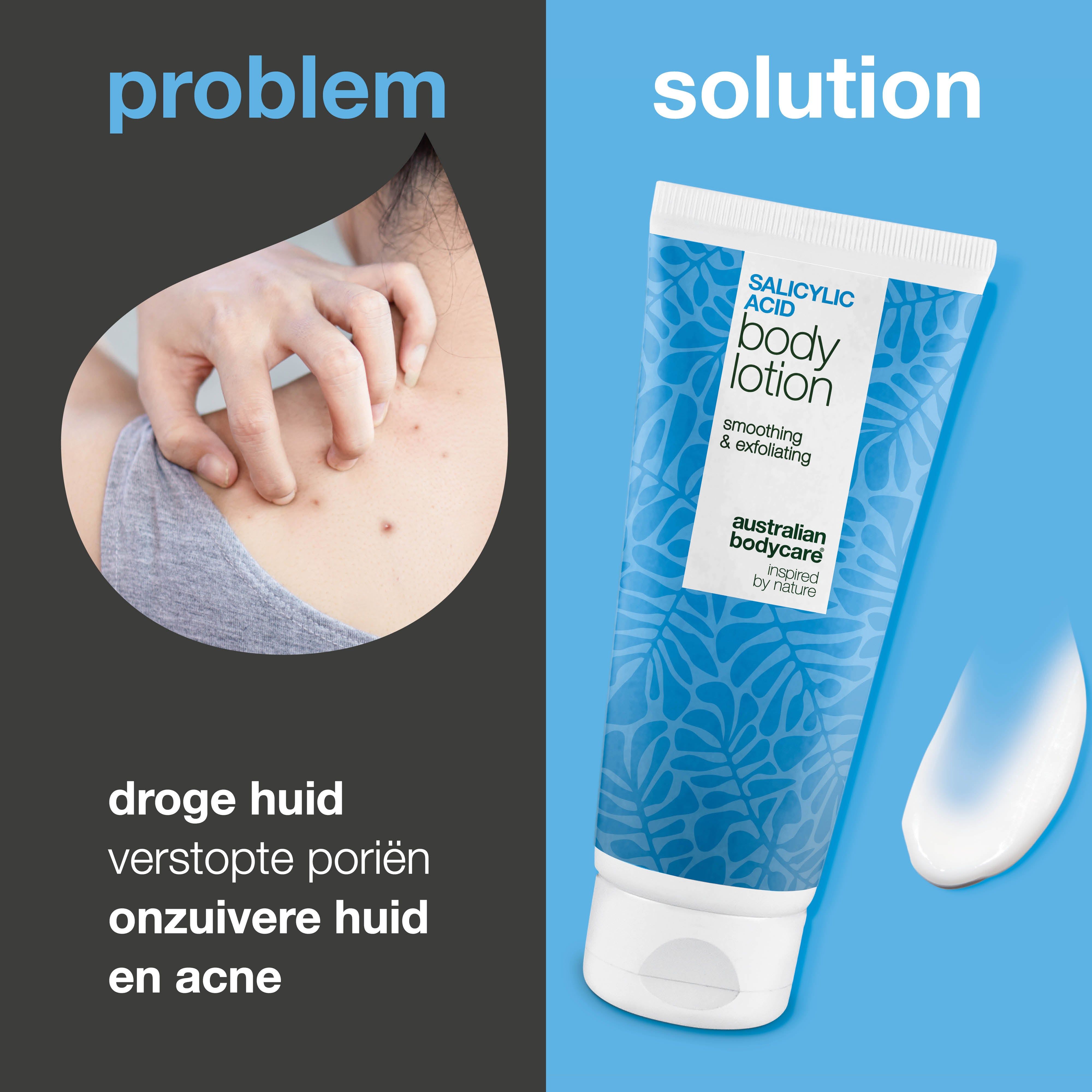 Vergelijking: huidprobleem en oplossing. Links: persoon krabt. Rechts: tube lotion met salicylzuur.