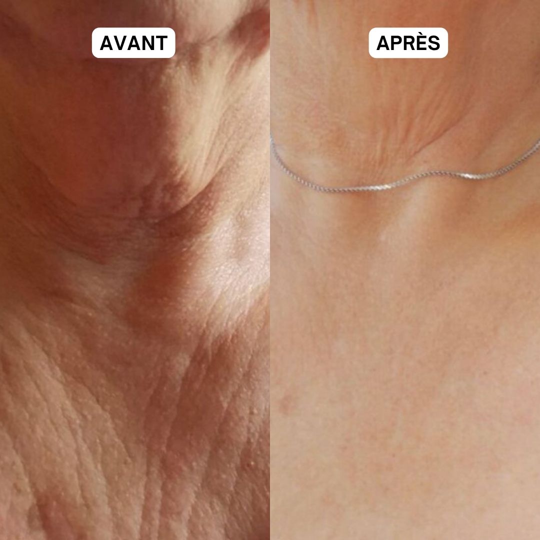 Comparaison avant-après du cou. À gauche : peau ridée. À droite : peau plus lisse.