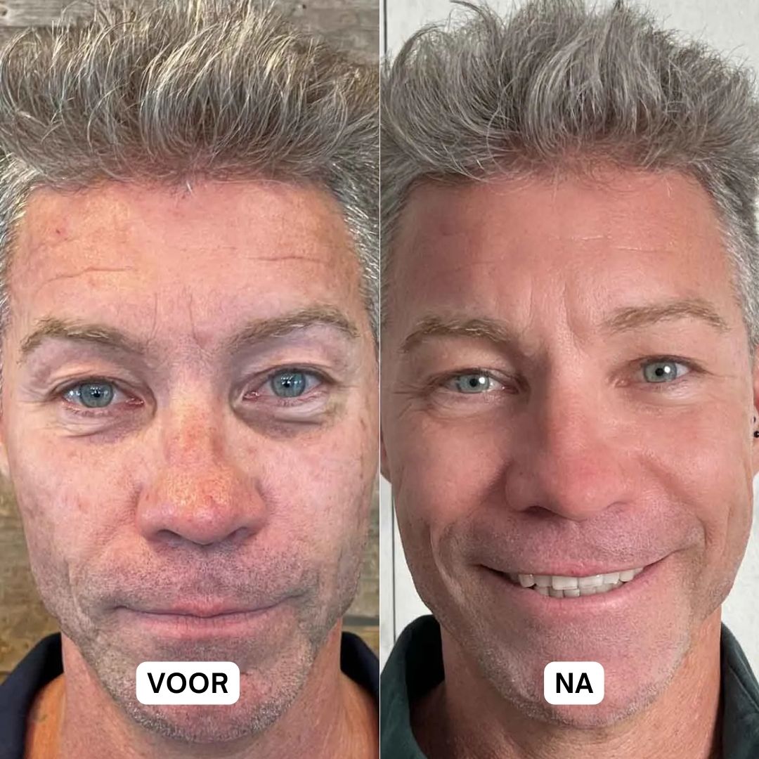 Voor-en-na vergelijking. Man met rimpels, dan gladder gezicht. Geen productinformatie.