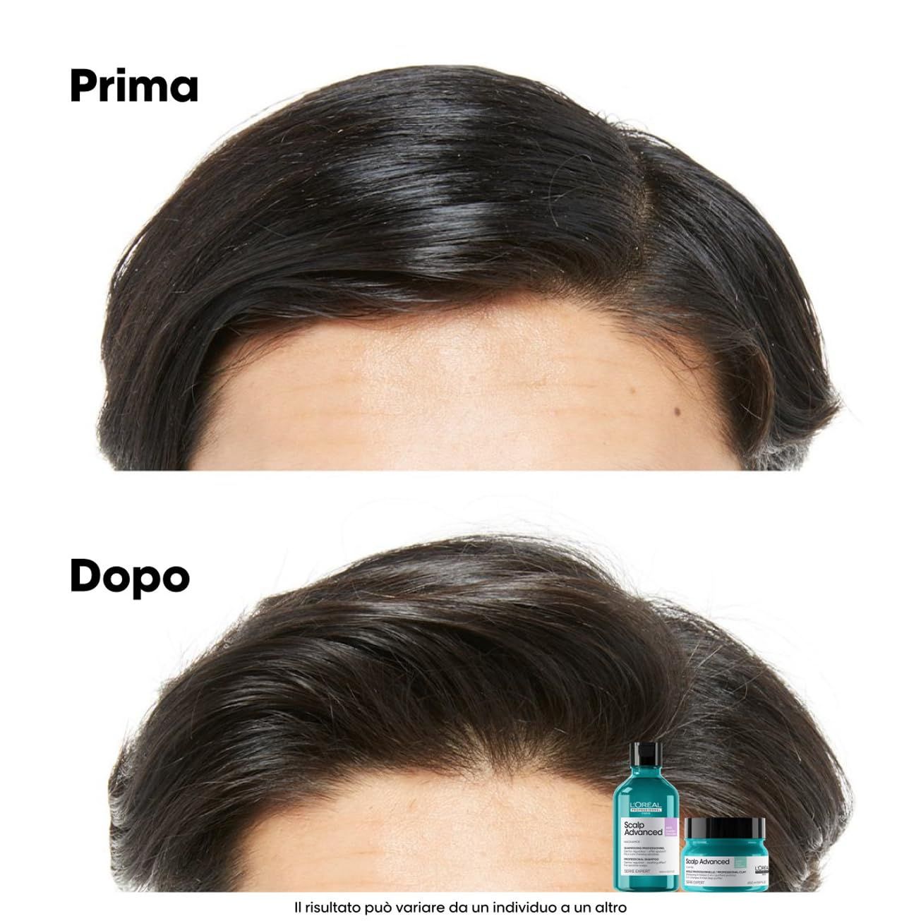 Comparaison avant-après des cheveux. En bas : shampooing et crème. Texte : Prima, Dopo. L'Oréal Professionnel Scalp Advanced.
