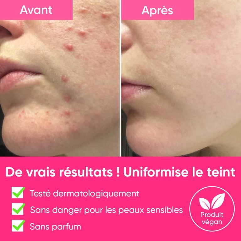 Comparaison avant-après de la peau traitée avec le peeling "Peels So Good" âme pure. Montre la réduction des imperfections.